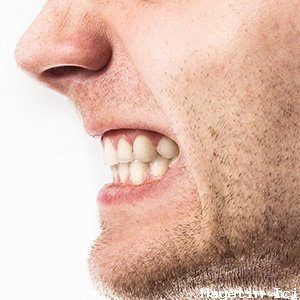 Gece diş gıcırdatma temporomandibular eklemlere zarar verebilir