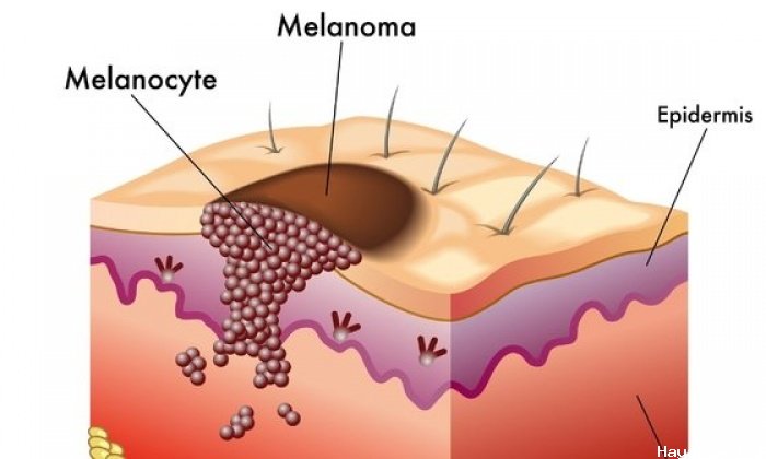 Melanom Hücreleri Üzerine Yapılan Bir Araştırma