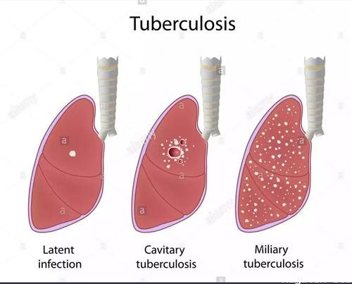 Tüberküloz ( Verem Hastalığı ) Nedir? Belirtileri ve Tedavi Yöntemleri