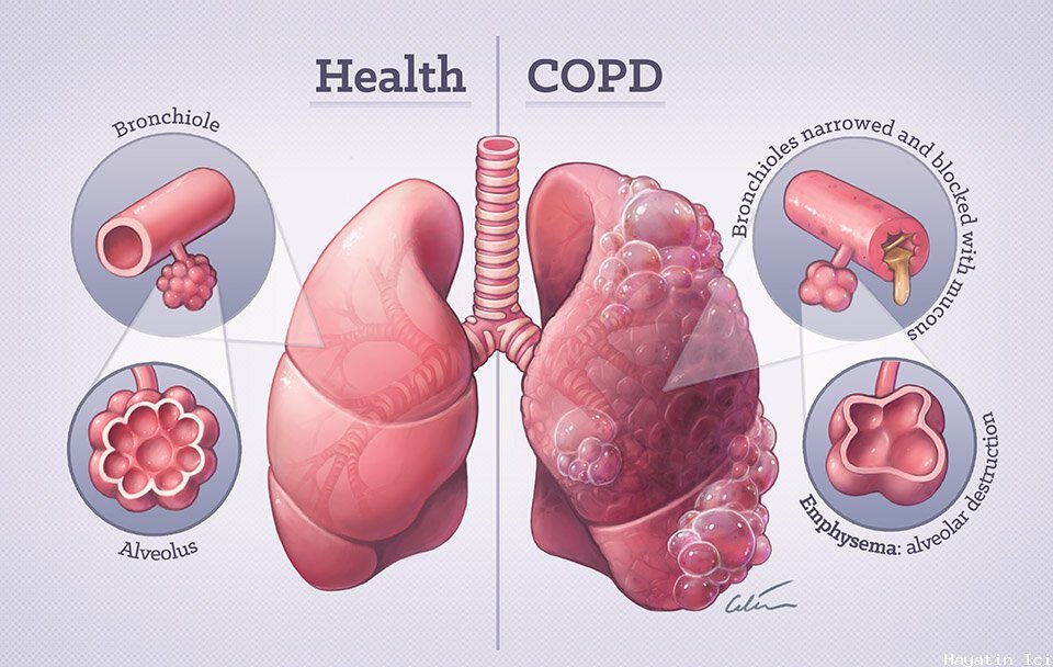 Kronik Obstrüktif Akciğer Hastalığı (KOAH) Hakkında Bilmeniz Gereken Her Şey
