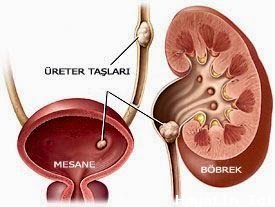 Böbrek Taşı