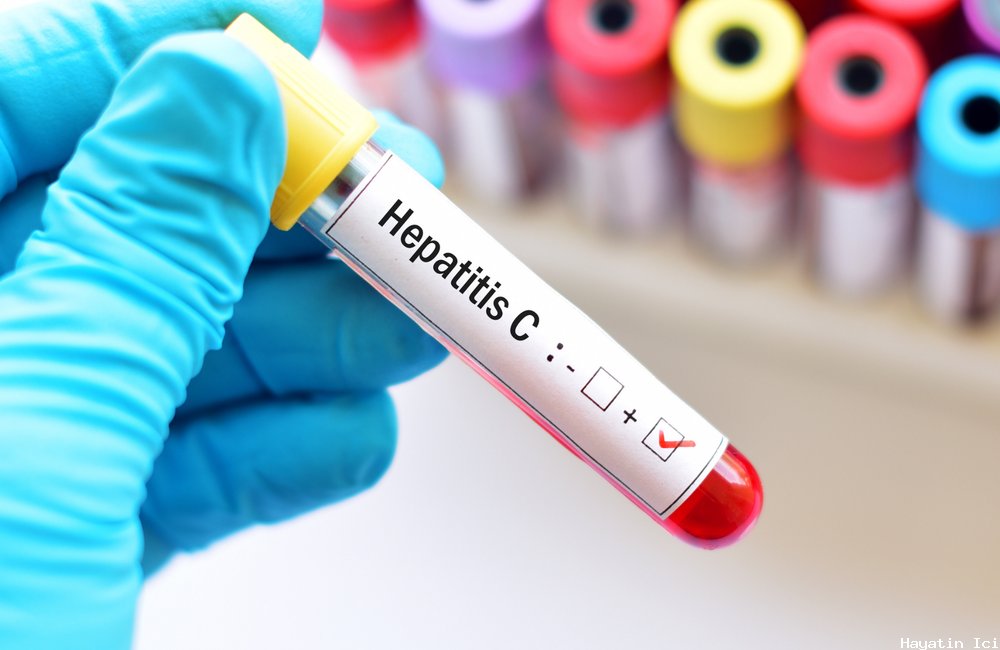 Hepatit C Tedavileri Nelerdir?