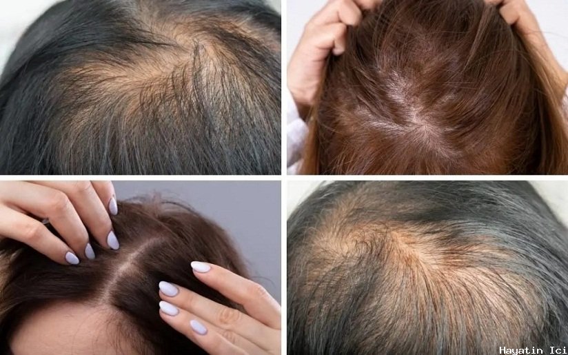 Alopesi (saç dökülmesi): nedenleri, belirtileri ve tedavileri