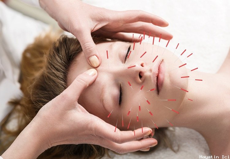 Akupunktur Nedir ? Akupunktur Çeşitleri ve Nasıl Uygulanır?