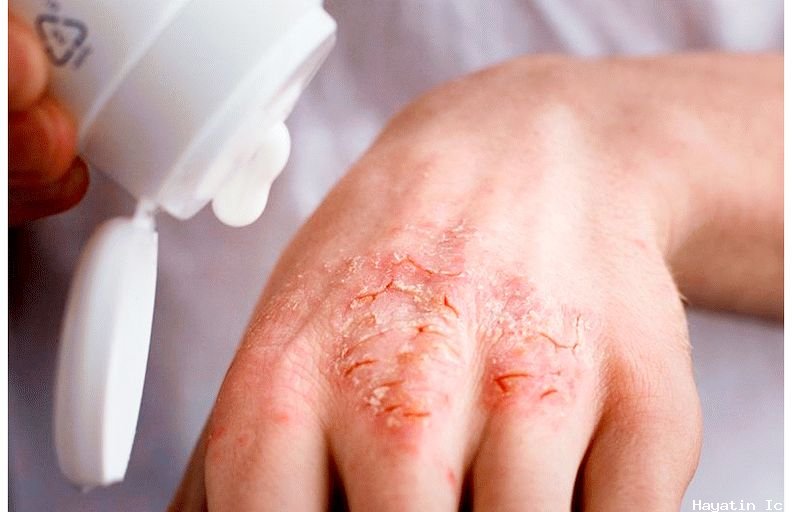 Egzama ( Atopik Dermatit ): Nedir, Belirtileri ve Tedavisi