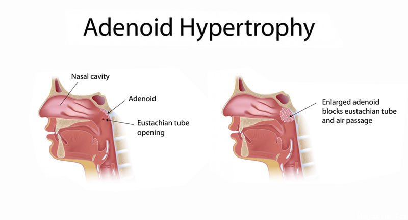 Geniz Eti ( Adenoid ) Nedir? Belirtileri ve Tedavi Yöntemleri Nelerdir?