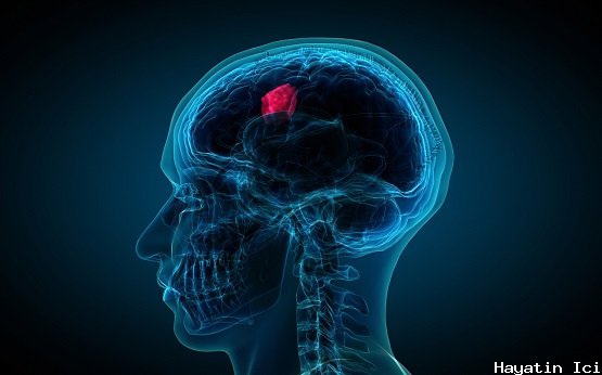 Beyin Tümörü teşhis ve tedavisi