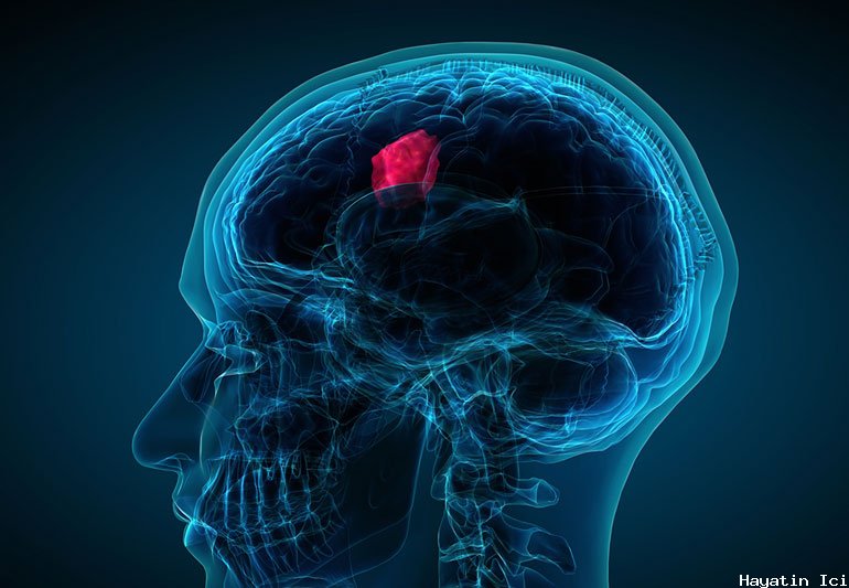 Beyin tümörü nedir, teşhis ve tedavi yönetmeleri nelerdir?
