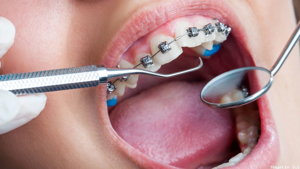 Diş teli tedavisi ortodonti